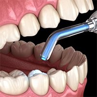 dental or tooth restorations