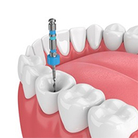 root canal treatement