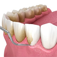 teeth scaling or polishing
