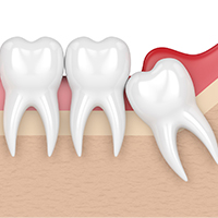 tooth impaction